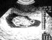 UltrasoundJun08_tn.GIF (2515 bytes)