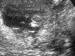 UltrasoundJun22_1_tn.GIF (2525 bytes)