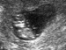 UltrasoundJun22_2_tn.GIF (2491 bytes)