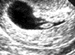 UltrasoundMay26_tn.GIF (2629 bytes)